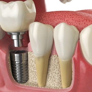 Illustrated dental crown being fitted over a dental implant