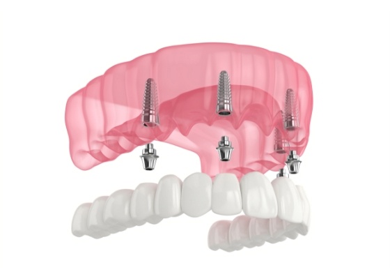 Illustrated denture being fitted over 4 dental implants