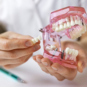 Dentist holding model of implant bridge