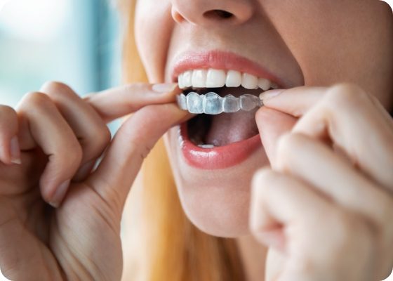 Close up of woman placing clear aligner over her teeth