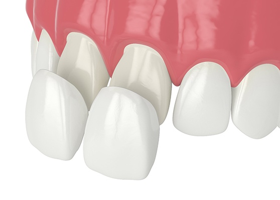 Illustration of veneers being placed on front teeth