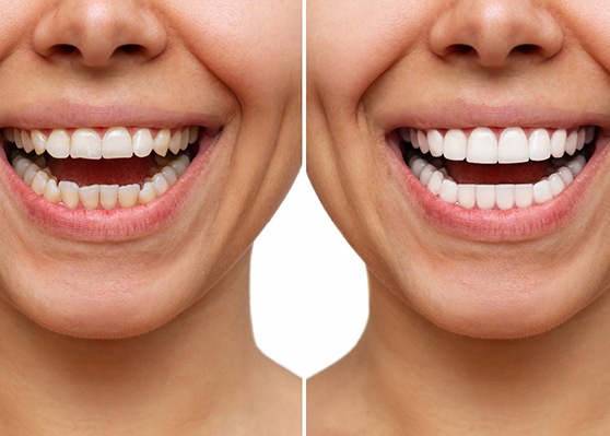 Closeup of patient's teeth before and after veneers