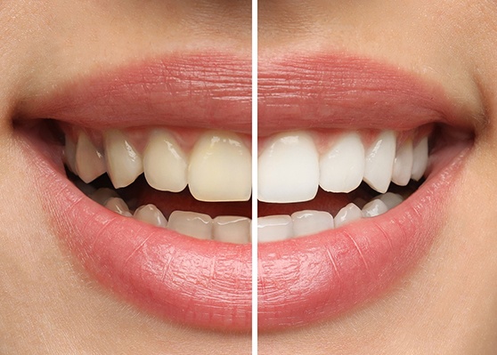 Closeup of a smile that’s half-whitened to show before/after results