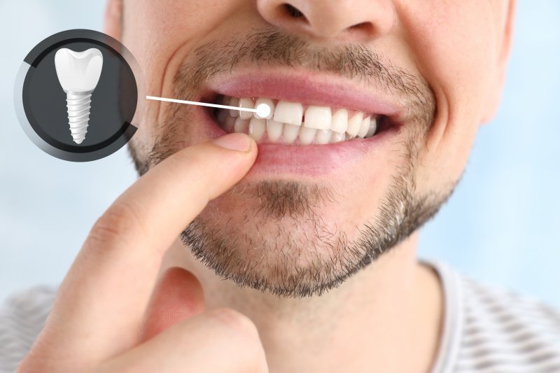 A photo highlighting a man’s successful dental implant